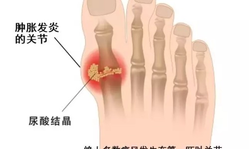 肺部肿瘤化疗后吃虾行吗-肺部肿瘤恶性化疗期间可以吃饭网肺部肿瘤恶性化疗期间可以吃饭吗知识网站,分享肺部肿瘤做化疗能活多久大全